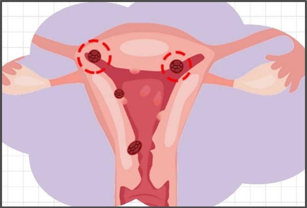 巧克力囊肿会影响试管成功率