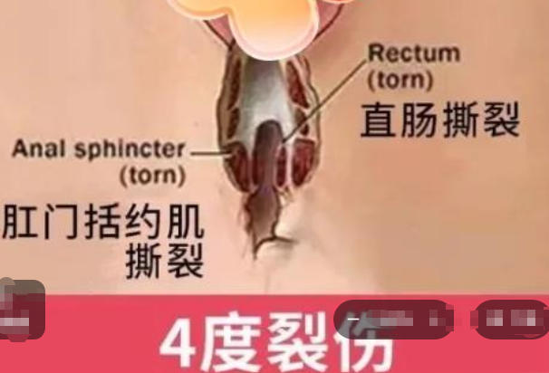 四度会阴裂伤
