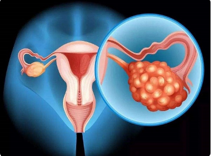 多囊卵巢可影响女性怀孕