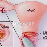 试管婴儿备孕期间可以性生活吗？三个阶段答案完全不同