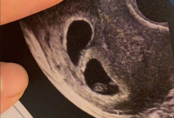 胚胎发育迟缓会影响试管一超结果