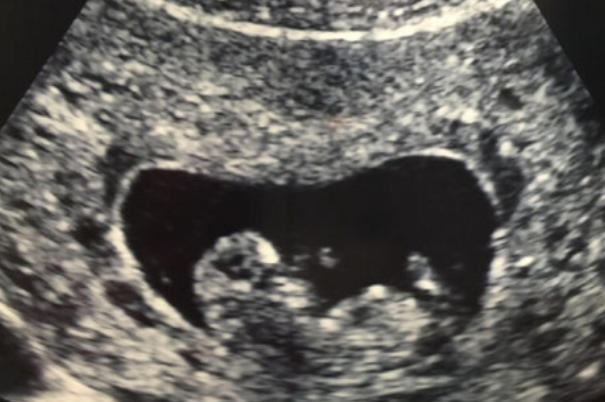 在妊娠16至20周B超可以检查胎儿是男是女