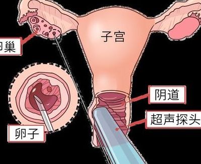 促排卵母细胞采集越多越好？当心“高产”反伤身，小周取到18颗后进了急诊
