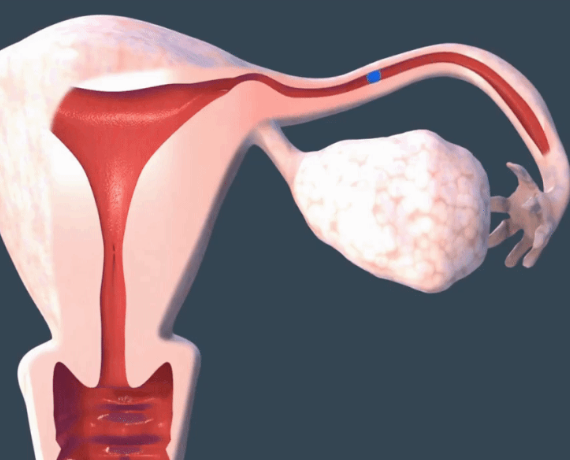 输卵管堵塞会降低怀孕几率