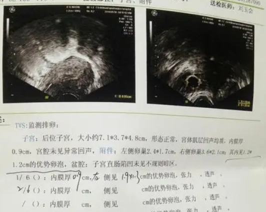 17mm卵泡也有可能受孕