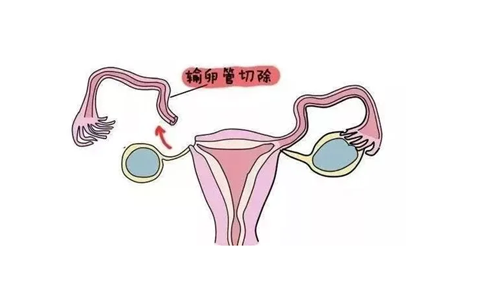 女人输卵管切除一边还能生育吗，双侧切除呢