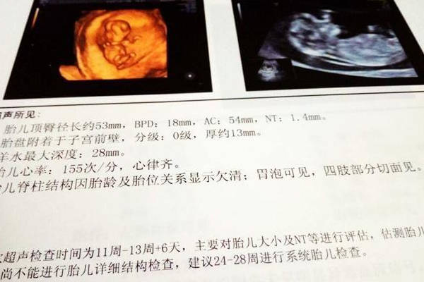 一文说清不配合nt检查的胎儿特点，宝宝可能不爱运动