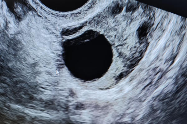 一个卵泡也有成功妊娠的希望