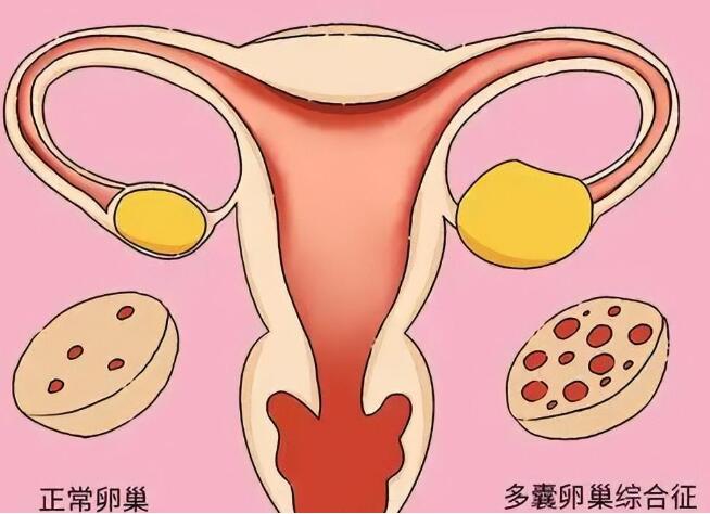 多囊女性适合拮抗剂方案