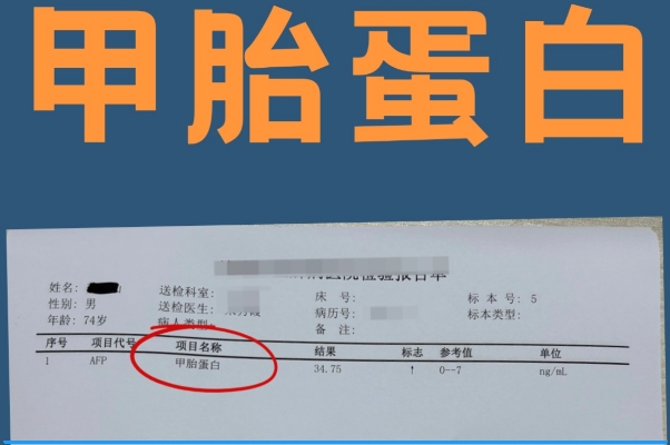甲胎蛋白偏高不一定代表恶性疾病