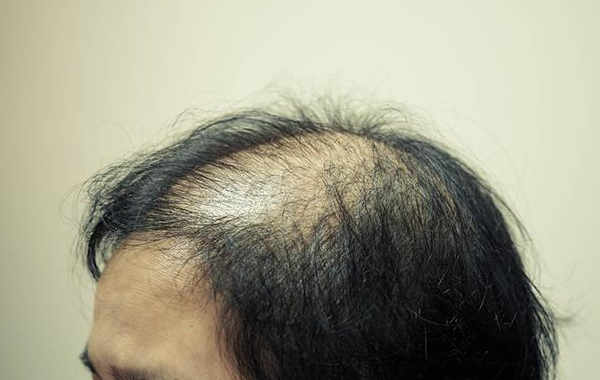 男性做三代试管婴儿能避免后代遗传秃顶?