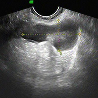 为什么试管促排时每次做b超卵巢左侧都有积水呢？