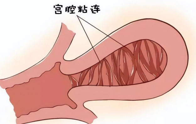 美国试管婴儿过程是怎样的