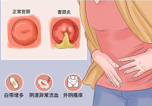 滴虫阴道炎严重不能做试管