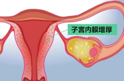 子宫内膜增厚是怀孕的症状吗.png