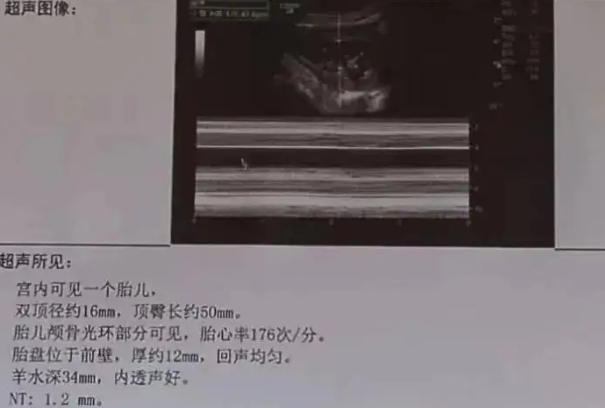 B超单上的x和y不能代表胎儿性别