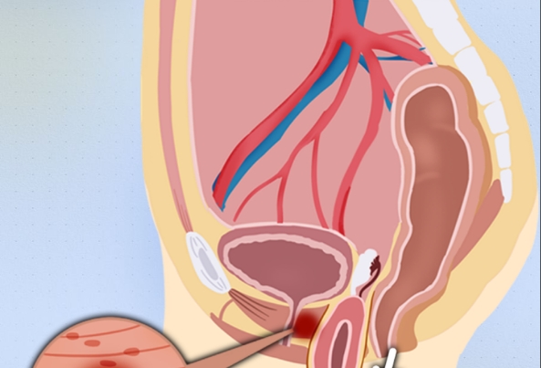 病情的严重程会影响子宫脱垂是否能自愈度
