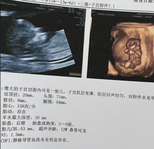 nt值不能判断胎儿性别