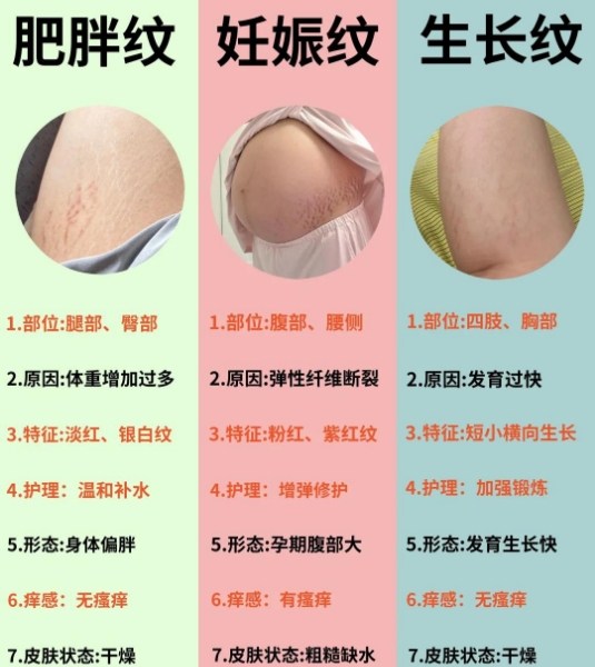肥胖纹和妊娠纹区别图