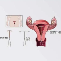 取环要检查什么?生完孩子到底要不要上环?