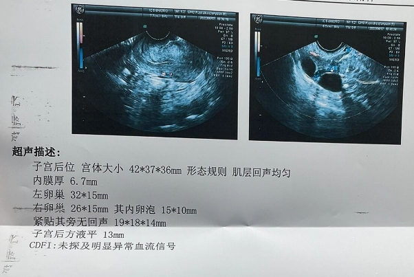 测卵泡可以提高受孕几率
