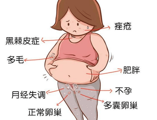 胖多囊可以直接促排吗?先看体重和代谢再决定