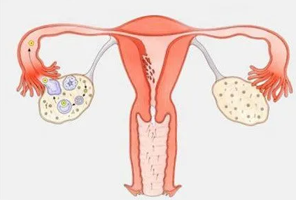 治卵巢早衰, 卵巢早衰对试管的影响
