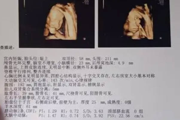 孕中期从彩超单上看胎儿是男孩还是女孩的诀窍是什么呢？