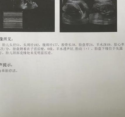 孕25周查出酮体2+，医生看完报告只说了一句话，我心跳漏了半拍