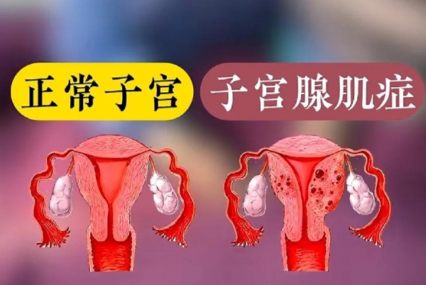 子宫腺肌症不一定需要运动缓解