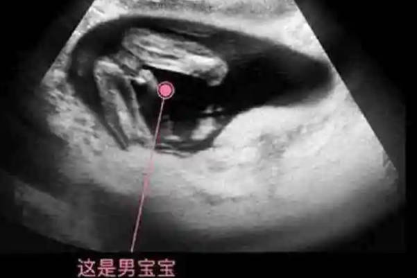 孕13周看胎儿是男孩还是女孩的误诊率高不高呢？