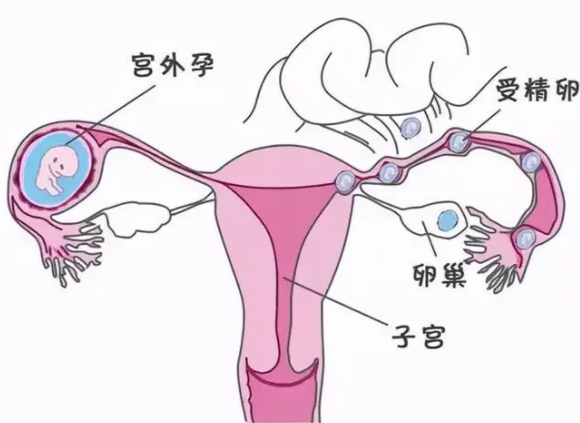 输卵管细长有什么影响，输卵管堵塞试管成功率高吗？