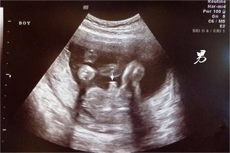14周胎儿生殖器官逐渐发育
