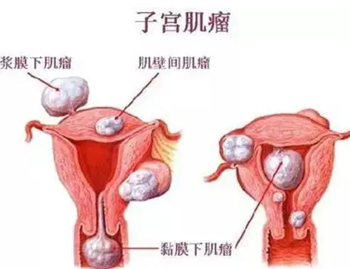 子宫肌瘤.png