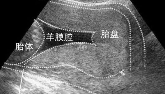 怀孕后壁一般是男孩还是女孩？胎盘后壁和生男生女真没关系