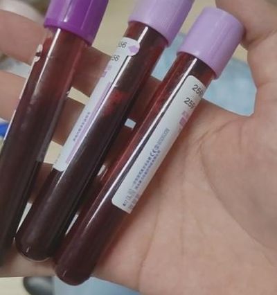 先天性无精症能生育吗？多少钱？过来人帮你梳理5笔费用开销明细