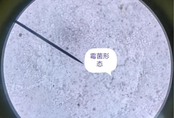 霉菌检查出来阳性不一定有问题