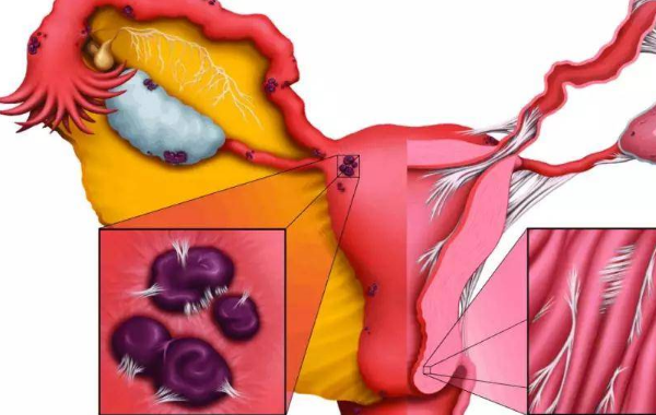 女性孕期有子宫前壁有结节影响怀孕?