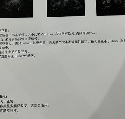 多囊卵巢综合症是什么原因造成的？我34岁确诊后才找到答案