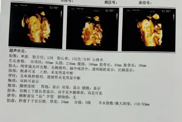 用四维单子上的双顶径减股骨长为1.3是代表生男孩吗？