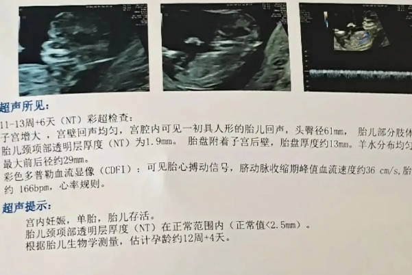 NT检查是评估胎儿颈部透明带的厚度