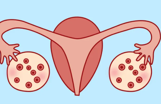 多囊卵巢综合征是一个常见的问题