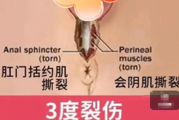 三度会阴裂伤