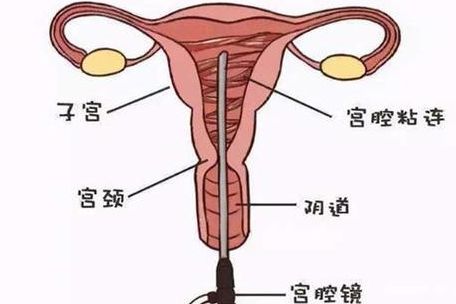宫腔粘连可以做试管吗？先别急着进周，这三步帮你避坑