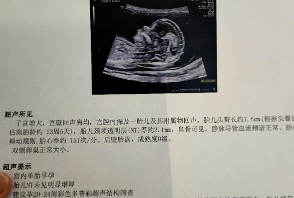 NT单子上无法看出男孩女孩