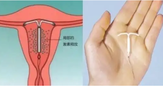 取环不一定全部需要刮宫