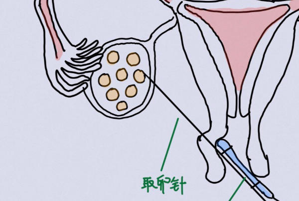 试管取卵数量会影响胚胎成率