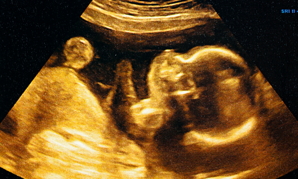 头大腿短可能暗示胎儿发育问题