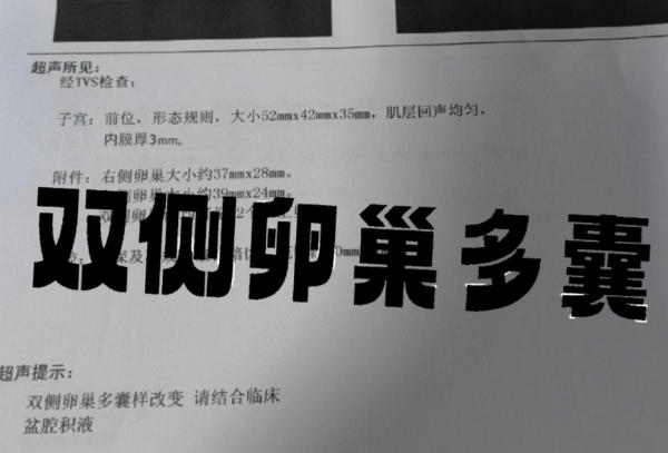 内分泌紊乱会导致双侧卵巢多囊样改变