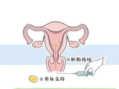 胚胎移植前后注意事项